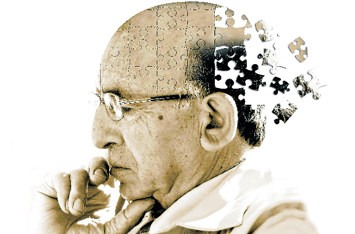 Las preguntas sobre el mal de Alzheimer