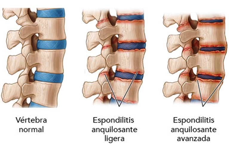 Hombres con dolor de espalda podrían padecer enfermedad reumática y no saberlo