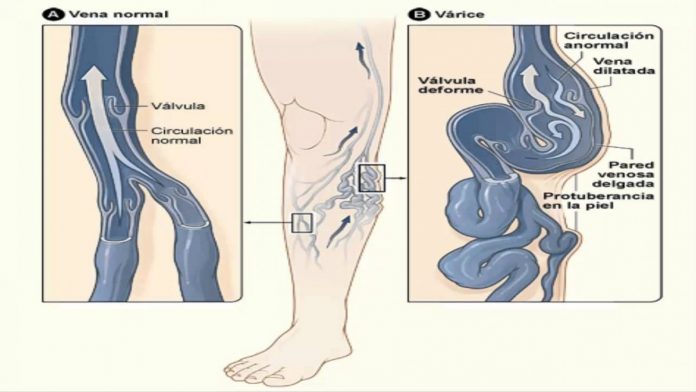 p15f1 dibujo varices