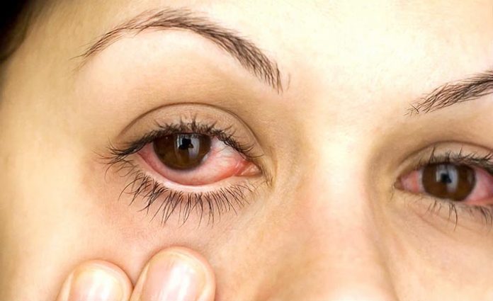 p17f1 ojo con conjuntivitis