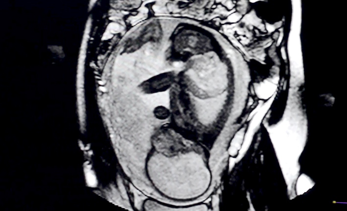 En Roentgen hicieron una resonancia fetal