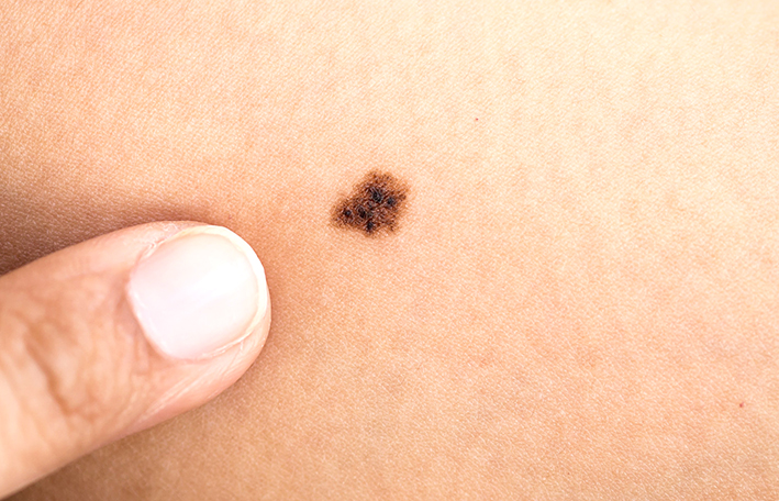 Melanoma, una epidemia mundial que es evitable