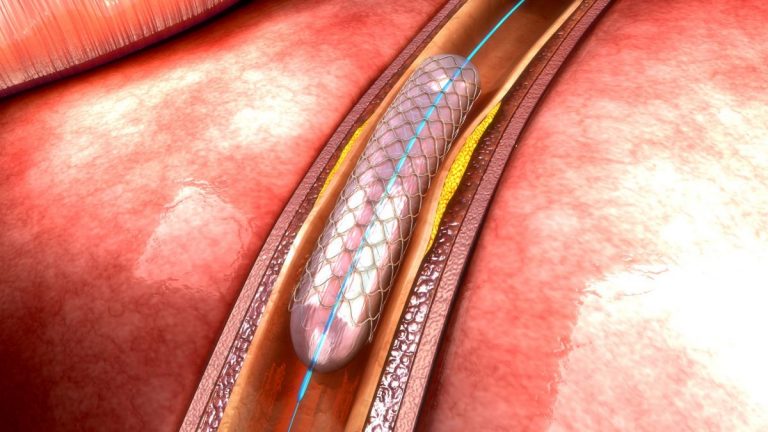 Creció el número de angioplastias en detrimento del bypass