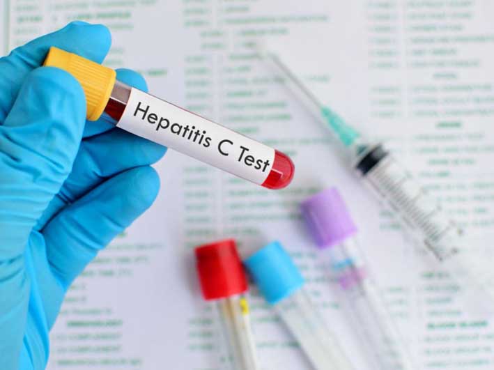 En 2018 estará disponible el test rápido de hepatitis C