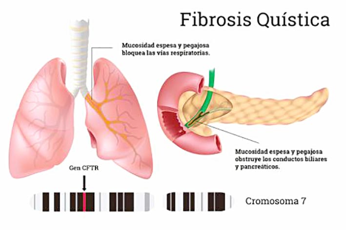 La fibrosis quística, una enfermedad genética