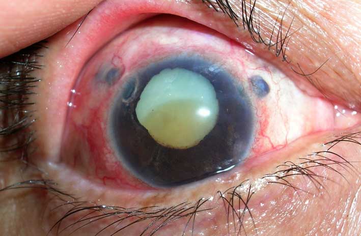 Todo acerca del glaucoma y sus síntomas