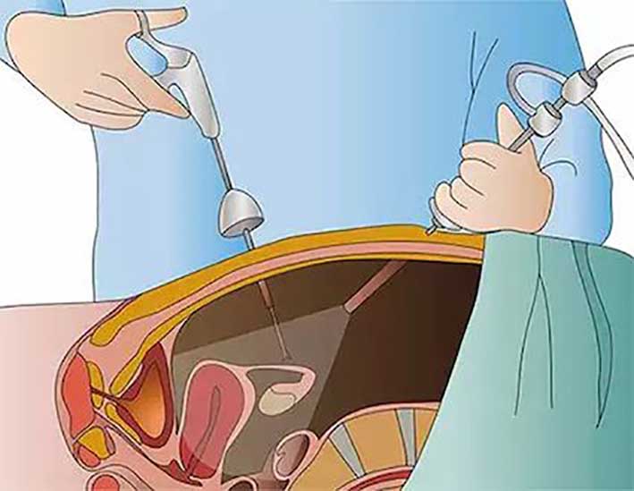 Cirugía laparoscópica: mejor opción para las patologías ginecológicas