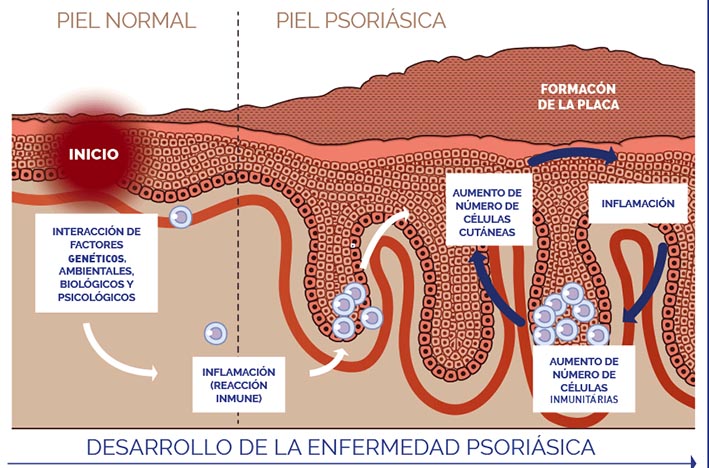 Una nueva terapia mejora las lesiones de la piel por psoriasis