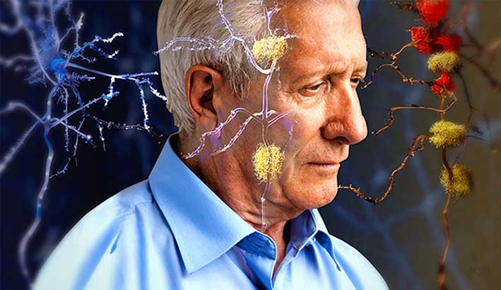 Relacionan al Alzheimer con virus de la infancia